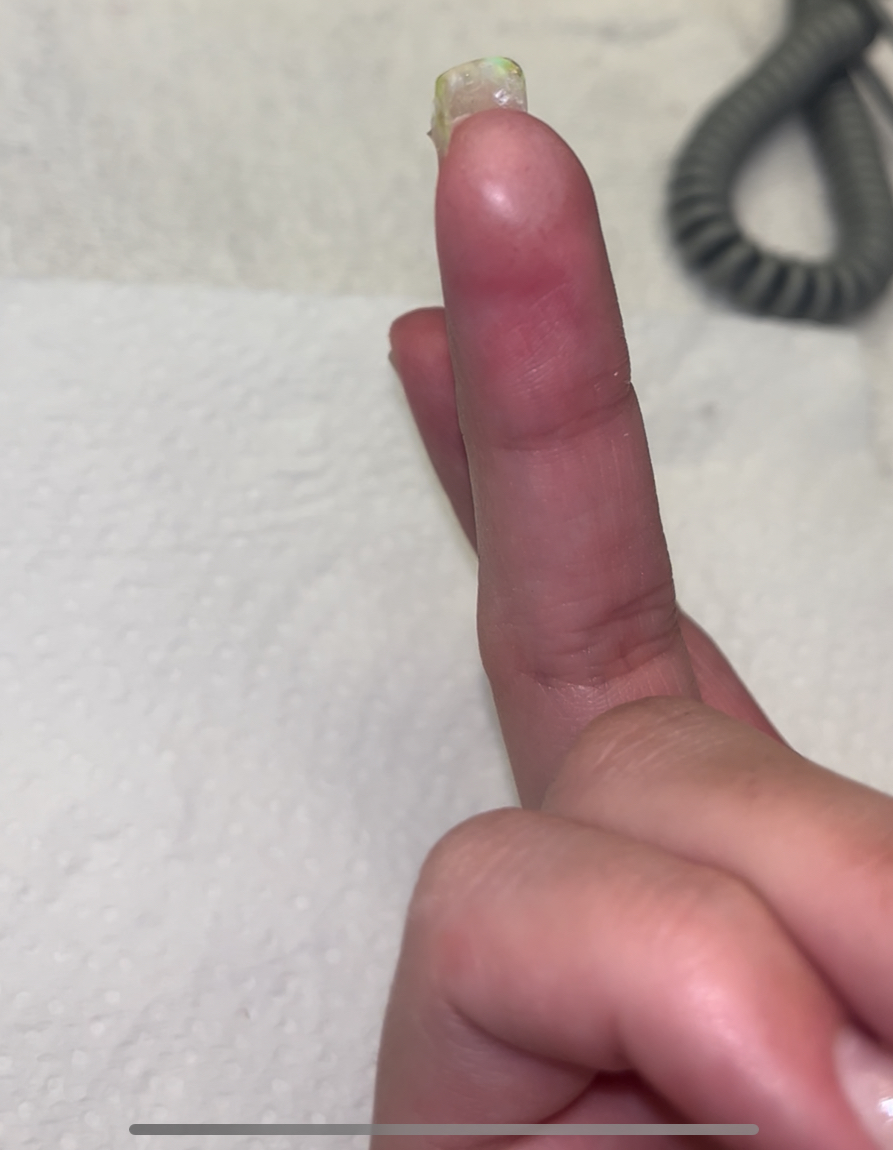 HEMA allergic reaction